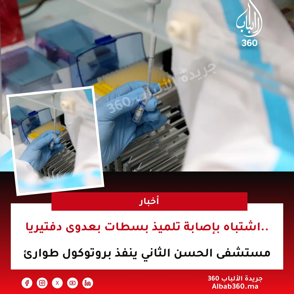 اشتباه بإصابة تلميذ بسطات بعدوى دفتيريا.. مستشفى الحسن الثاني ينفذ بروتوكول طوارئ