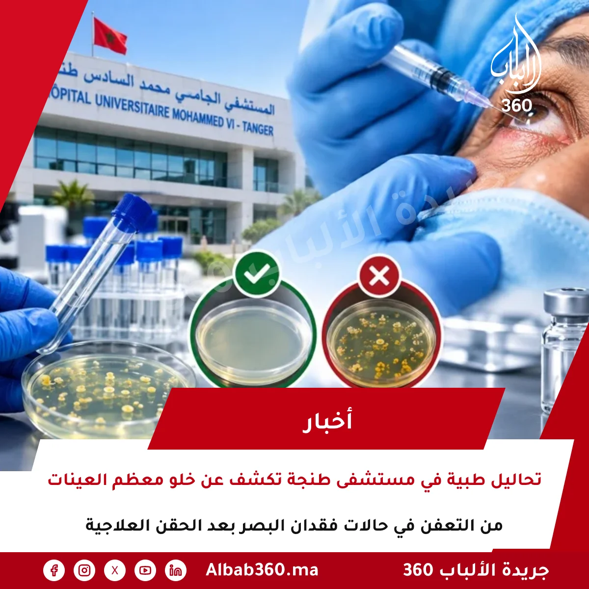 تحاليل طبية في مستشفى طنجة تكشف عن خلو معظم العينات من التعفن في حالات فقدان البصر بعد الحقن العلاجية